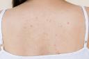 A Practical Approach to Treating Back Acne on Oily Skin
