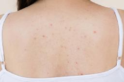 A Practical Approach to Treating Back Acne on Oily Skin