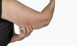 Arm Lift Surgery Options: A Complete Overview