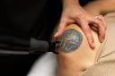 Laser Tattoo Removal Costs in Riyadh: Factors to Consider