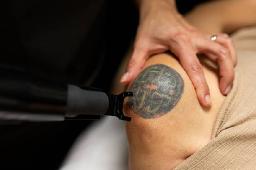 Laser Tattoo Removal Costs in Riyadh: Factors to Consider