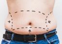 Tummy Tuck Surgery for Enhancing Your Natural Body Silhouette