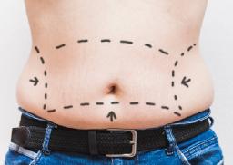 Tummy Tuck Surgery for Enhancing Your Natural Body Silhouette