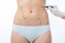 Liposuction in Riyadh: How to Set Realistic Body Contouring Goals