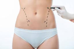 Liposuction in Riyadh: How to Set Realistic Body Contouring Goals