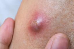 Why Cyst Removal Prices Vary Between Clinics