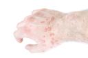What Are the Different Types of Eczema?