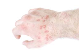 What Are the Different Types of Eczema?