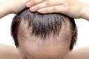 How Does PRP Hair Treatment Help With Hair Loss?