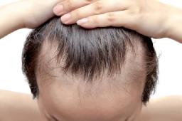 How Does PRP Hair Treatment Help With Hair Loss?